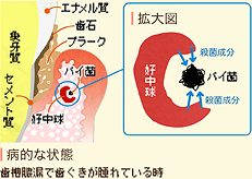 免疫療法による歯槽膿漏の治療